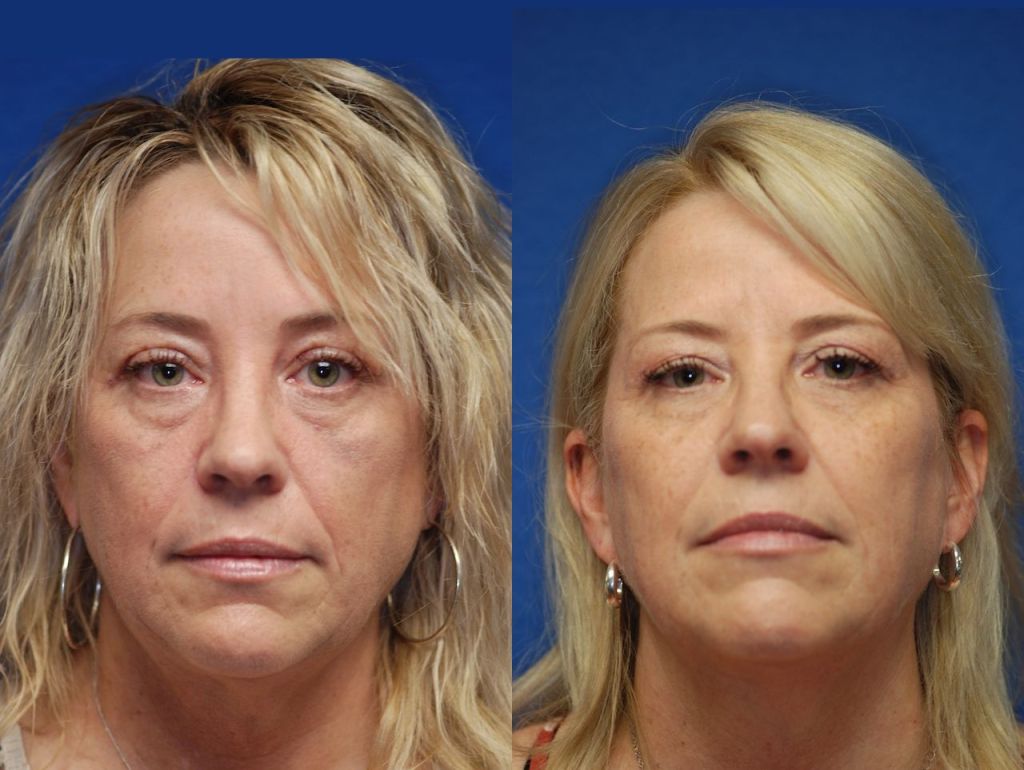 Brow Lift - Penn Medicine Cosmetic Services